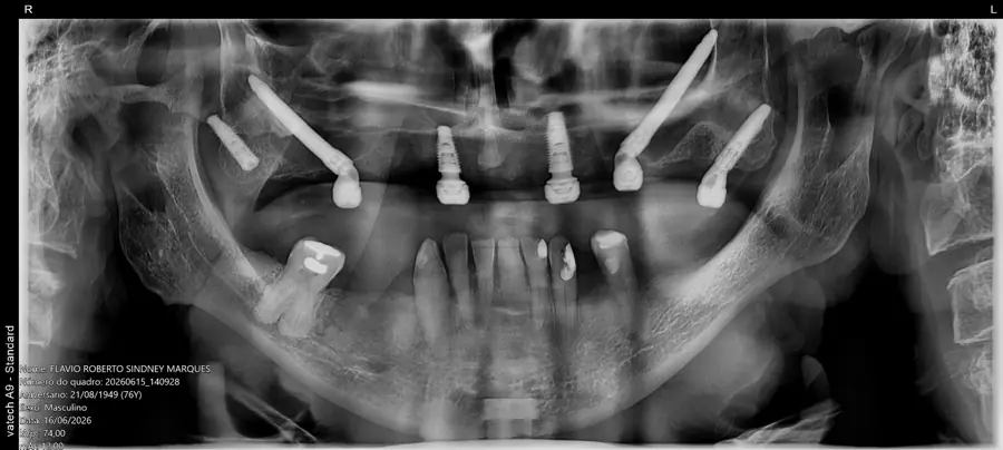 Radiografia panorâmica do caso zigomático